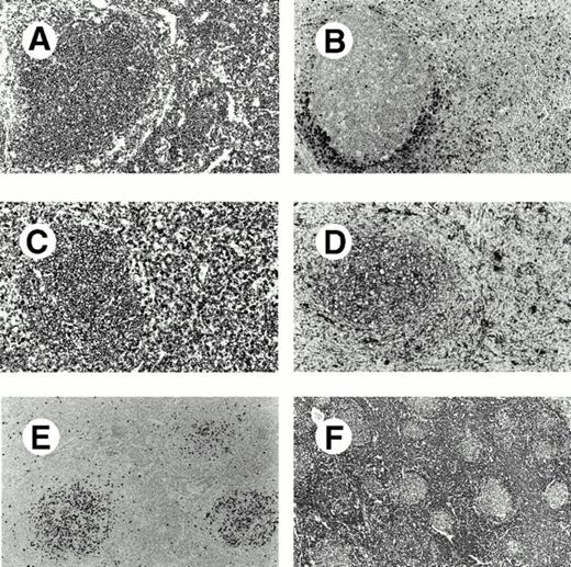 Fig. 2. Immunophenotype of interfollicular neoplastic B cells in paraffin sections of follicular lymphoma. (A-F) Serial sections of a follicular lymphoma (case 13) immunostained for CD20 (A), IgD (B), Ig κ light chain (C), Ig λ light chain (D), Ki67 (E), and bcl-2 protein (F). There are numerous CD20+ B cells both in the follicles and the interfollicular zone. IgD+ cells are concentrated in a narrow follicular mantle and scattered in the interfollicular area. There is Ig κ light chain restriction both in the follicular and interfollicular B cells showing the neoplastic nature of both cell populations. Immunostaining for Ki67 antigen shows that follicular neoplastic B cells have a much higher proliferation fraction than the interfollicular component (E) and Bcl-2 immunostaining shows that bcl-2 is expressed by both follicular and interfollicular neoplastic B cells (F). (A-F, immunoperoxidase)
