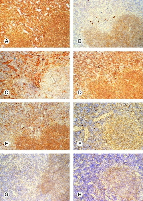 Fig. 3. Immunophenotype of interfollicular neoplastic B cells in frozen sections of follicular lymphoma. (A-F) Serial sections of case 6 immunostained for CD20 (A), CD10 (B), Ig κ light chain (C), Ig λ light chain (D), CD38 (E), and CD95 (F). The interfollicular zone contains an Ig λ light chain restricted B-cell population. CD10, CD38, and CD95 are expressed by the neoplastic follicle but not by the neoplastic B cells of the interfollicular zone. (G,H) Sections of case 1 immunostained for CD80 (G) and case 2 for CD86 (H) show that CD80 and CD86 are expressed in the follicles but are downregulated in the interfollicular zone. (A-H, immunoperoxidase)