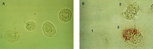 Fig. 2. Detection of HIV-1 p24-positive cells and cytokine mRNA expressing cells by combined immunocytochemistry and in situ hybridization. (A) Negative control (LPS-stimulated, uninfected MAC hybridized with IL-8 sense oligonucleotides). (B) Simultaneous detection of HIV-1 p24 (red staining) with immunocytochemistry and IL-8 mRNA in LPS-stimulated MAC with in situ hybridization (dark granules) at day 22 after start of culture. Cell no. 1, HIV p24-negative and IL-8–negative; cell no. 2, HIV p24-negative and IL-8–positive; cell no. 3, HIV p24-positive and IL-8–positive (×1,500).