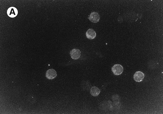 Fig. 1. RARα (A) and PML (B) immunofluorescence labeling of bone marrow cells derived from one of the two patients.