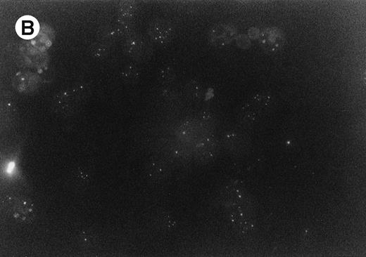 Fig. 1. RARα (A) and PML (B) immunofluorescence labeling of bone marrow cells derived from one of the two patients.