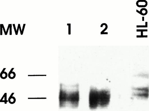 Fig. 2. Western blot analysis of RARα in nuclear extracts of bone marrow cells from patient no. 1 (lane 1) and patient no. 2 (lane 2). Nuclear extract was prepared from HL60 cell line as a control of normal RARα expression.
