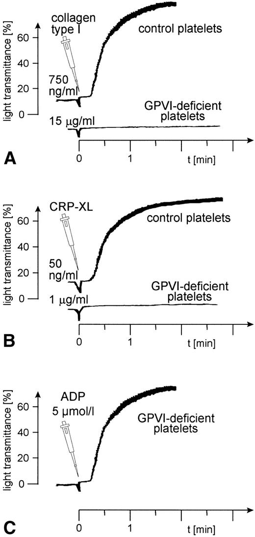 Fig. 6. Aggregation of GPVI-deficient and control platelets induced by (A) collagen type I, (B) CRP-XL, and (C) ADP. The platelet count had to be adjusted to 1.8 × 108/mL because the patient was slightly thrombocytopenic. Collagen and CRP-XL did not induce platelet aggregation in GPVI-deficient platelets, although these platelets were able to aggregate in response to ADP. Data shown are representative of three similar experiments.