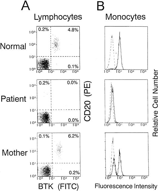 Fig. 3. Flow cytometric analysis of cellular BTK expression in a normal donor and in an XLA patient (family 19) and his mother. Dot plot maps of BTK versus CD20 gated for lymphocytes (A) and histograms gated for CD14+ monocytes (B) were obtained as described in the legend of Fig 2. Five thousand cells were evaluated in each gated population. The dashed line indicates the control antibody.