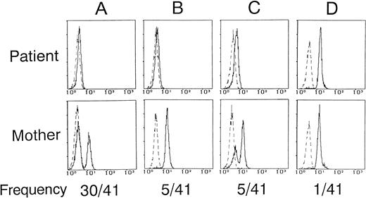 Fig. 4. Relationship of monocyte BTK expression profiles between XLA patients and their mothers. Each histogram represents analysis of CD14+ monocytes. The solid and dashed lines indicate the staining with anti-BTK and control antibodies, respectively. Five thousand cells were evaluated in each gated population. (A) The patient had the complete BTK deficiency, and the mother showed the mosaic BTK expression (eg, family 13). (B) The patient had the complete BTK deficiency, but the mother showed the single-positive BTK expression (eg, family 14). (C) The patient had the partial BTK deficiency, and the mother showed the mosaic BTK expression with dimly BTK+ cells and brightly BTK-expressing cells (eg, family 7). (D) Both the patient and the mother expressed the normal BTK expression (eg, family 6). The frequency (no. of families/total no. of families) is depicted below the histogram.