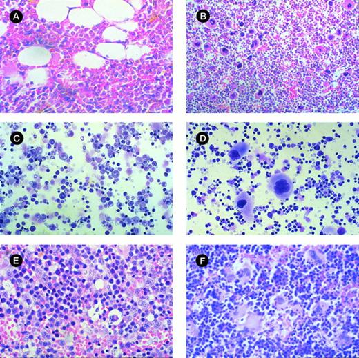 Fig. 4. Morphologic analysis of murine BM and spleen engrafted with CML cells. (A) Histologic section of tibia of NOD/SCID mouse irradiated but not infused with human cells at day 42 (original magnification × 400). (B) Histologic section of tibia of mouse with 28% human cells detectable at day 42. Hypercellular marrow with proliferation of megakaryocytes and eosinophils are shown (original magnification × 400). (C) Histologic section of spleen from control mouse showing monomorphic lymphoid population (original magnification × 400). (D) Histologic section of spleen of mouse with 33% human cells detectable at day 42. Infiltration with megakaryocytes is shown. (E) Cytospin preparation of spleen from control mouse (original magnification × 400). (F) Cytospin preparation of spleen of mouse with 56% human cells detected at day 42 showing prominent magakaryocytes (original magnification × 400).
