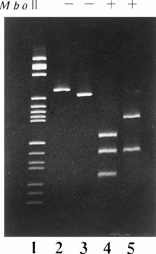 Fig. 3. PCR-RFLP analysis of the cDNA derived from the EBV-LCL of H.A. cDNA fragments extending from base 200 to base 495 were enzymatically amplified from mRNA of the EBV-LCL of H.A. and normal individuals. The PCR products, both before (−) and after (+) digestion with the restriction enzyme Mbo II were analyzed on 5% polyacrylamide gel stained with ethidium bromide. Lane 1, pBR322HaeIII digest size marker; lanes 2 and 4, normal controls; lanes 3 and 5, H.A.