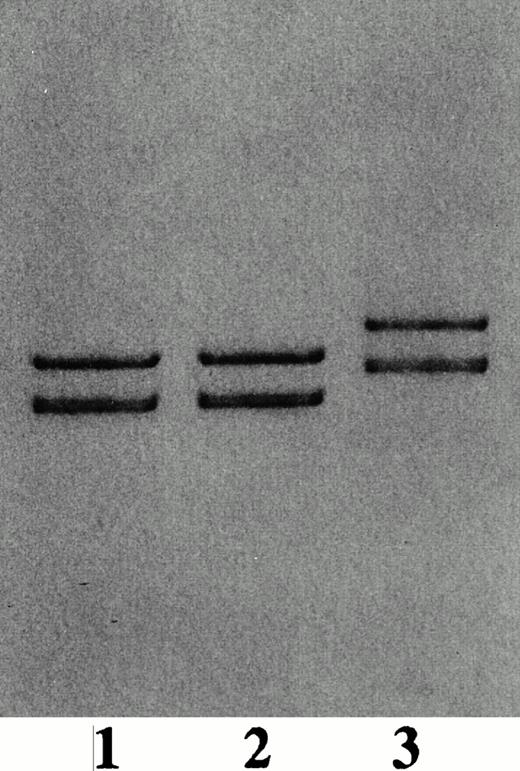Fig. 4. PCR-SSCP analysis of exon 2/intron 2 boundary region of H.A. and normal controls. Bases 1,531 to 1,750 were enzymatically amplified from genomic DNA from H.A. and normal control. Electrophoresis was carried out at 38°C. Lanes 1 and 2, normal controls; lane 3, H.A.