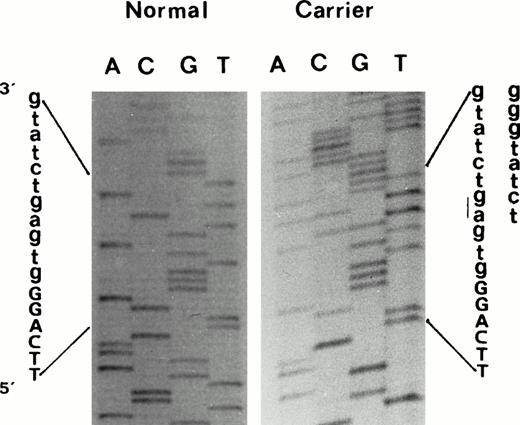 Fig. 2. Direct sequencing of exon2/intron2 β-globin gene region of amplified double-strand DNA from propositus, using a forward primer, which shows the 2-nucleotide deletion (-AG) at position IVS-II-4,5. Deletion was confirmed by sequencing the same DNA region using an appropriate reverse primer.