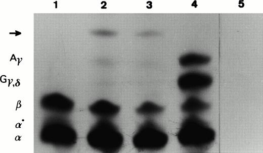 Fig. 4. In vitro translation of total reticulocyte RNA isolated from peripheral blood samples of (1) a normal β-globin control, (2 and 3) a carrier (IV7, V6) of IVS-II-4,5 (-AG) mutation, (4) a newborn normal β-globin control, and (5) an in vitro translation reaction to which no exogenous RNA was added. The 35S-labeled translation products were resolved in a Triton-acid-urea polyacrylamide gel. The position of α, α°, β, Gγ, δ, andAγ globins are indicated on the left of the autoradiograph. Abnormal peptide is marked by an arrow.
