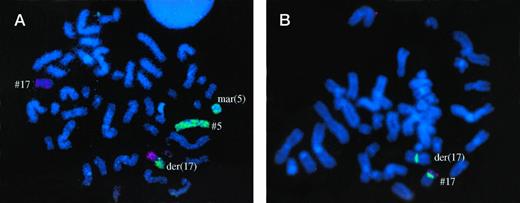 Fig. 1. Patient no. 3, with typical der(17) t(5;17) by GTG banding and WCP, and loss of one p53 allele. Some chromosome 5 material was found on a marker chromosome.