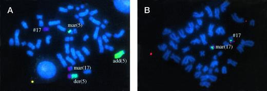 Fig. 2. Patient no. 8, with der(5) t(5;17) by GTG banding and WCP. Non identified chromosome material was translocated on the other chromosome 5 (add(5)). Some chromosome 5 material was also found on a marker chromosome (mar(5)). Another marker chromosome contained chromosome 17 material which included the p53 gene (fig 2B) and other markers studied on 17p. This marker (mar(17)) also contained chromosome 7 material. Therefore, this patient apparently had no visible deletion of 17p material.