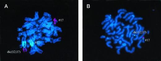 Fig. 3. Patient no. 11, where RHG banding suggested presence of der(12) t(12;17). FISH analysis showed that chromosome 17 centromere was also present on the derivative chromosome, which was therefore a dic (12;17). One p53 allele was deleted.