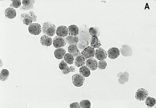 Fig. 1. Alkaline phosphatase immunocytohistochemical staining using the MoAb LRP-56 of cytocentrifuged bone marrow cells containing >95% plasma cells of a patient with multiple myeloma. Cytospins were counterstained in diluted hemotoxiline. LRP immunoreactivity in a granular fashion in the cytoplasm is present in almost all plasma cells (A). Isotype control is negative (B).