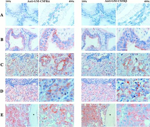 Fig. 4. Immunolocalization of GM-CSF receptors in benign and malignant human prostate tissues. Consecutive tissue sections were incubated with anti-α (left panel) or anti-β–subunit (right panel) antibodies. (A) Low to undetectable levels in the epithelial cells of the normal gland. (B) Moderate levels of expression in the epithelial cells of benign prostatic hyperplasia. (C) Increased immunoreactive pattern in a primary tumor. (D) High levels of expression in a lymph node and a bone (E) metastases. Stars in bone metastases images indicate bone location. Two different magnifications of each immunostained tissue section are shown (160× and 400×).