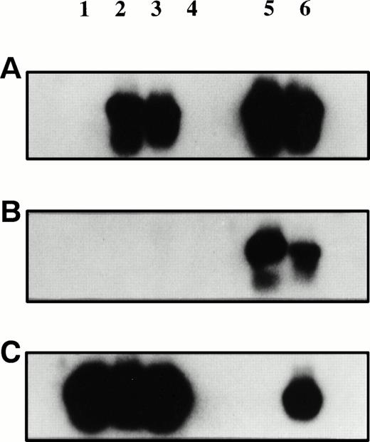 Fig. 1. Plasmacytoma biopsy samples before and after injection of AdCAIL-2 were PCR-amplified using primers specific for AdCAIL-2 (A), Ad5 E1 (B), or B-actin (C). PCR products were detected using internal radiolabeled probes. Lane 1, tumor biopsy sample preinjection; lane 2, tumor biopsy sample 7 days postinjection; lane 3, tumor at autopsy; lane 4, negative control—mock DNA extraction from autopsy tumor; lanes 5 and 6, positive controls. No E1 sequences from wild-type adenovirus were detected in the tumor. In contrast, AdCAIL-2 was readily detected in the postinjection biopsy samples.