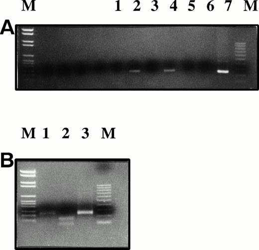 Fig. 2. RT-PCR for hIL-2 mRNA was performed and the products detected by ethidium gel. The PCR product was isolated (Geneclean) andMwo I restriction enzyme digestion shows that the hIL-2 amplified from the tumor is predominantly derived from the AdCAIL-2 vector. (A) RT-PCR for hIL-2. Lanes 1, 3, 5, and 6: negative controls; lane 2: tumor biopsy sample 7 days postinjection; lane 4: normal donor phytohemagglutinin-activated T lymphocytes; lane 7: AdCAIL-2 plasmid positive control. (B) PCR products from (A) were digested withMwo I. Lane 1: PCR product from tumor biopsy sample; lane 2: normal donor activated T cells; lane 3: plasmid control. The IL-2 in the tumor post injection is predominantly derived from AdCAIL-2 and does not digest with Mwo I.