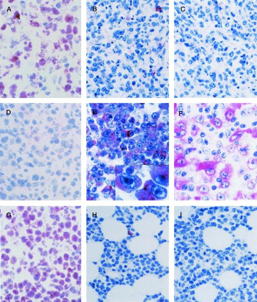 Fig. 1. AIDS-related systemic NHLs. (A through C) AIDS-LNCCL displaying the BCL-6+ (A), CD138/syndecan-1 (syn-1)− (B), LMP-1− (C) phenotype. (A) Large tumor cells show a nuclear staining pattern with anti–BCL-6 MoAb. (B) A residual plasma cell shows cytoplasmic staining for anti–syn-1 MoAb. (C) No LMP-1 expression is detectable. (D through F) AIDS-IBLP displaying the BCL-6− (D), syn-1+ (E), LMP-1+ (F) phenotype. (D) No BCL-6 expression is detectable. (E) Most immunoblastic-plasmacytoid tumor cells show strong cytoplasmic immunoreactivity with the anti–syn-1 MoAb. (E inset) A higher-power photograph showing the cytoplasmic staining pattern on large immunoblasts-plasmacytoid. (F) LMP-1 positivity is manifested as cytoplasmic or membrane staining on several large tumor cells displaying immunoblastic-plasmacytoid morphology. (G through I) AIDS-SNCCL displaying the BCL-6+ (G), syn-1− (H), LMP-1− (I) phenotype. (G) Most neoplastic cells show strong nuclear immunoreactivity with the anti–BCL-6 MoAb. (H) A residual plasma cell shows cytoplasmic staining for anti–syn-1 MoAb. (I) No LMP-1 expression is detectable. APAAP immunostaining; (A), (D), (G) frozen section; (B), (C), (E), (E inset), (F), (H), (I) paraffin-embedded tissue section, hematoxylin counterstain. Original magnification ×250 (A through I).