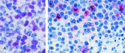 Fig. 2. AIDS-PCNSL. (A) BCL-6 protein expression in a case of AIDS-PCNSL (diffuse large cell lymphoma). The microphotograph shows that the tumor is relatively monomorphous and consists of large tumor cells displaying a large noncleaved cell morphology. In this field, nuclear positivity for BCL-6 is present on several tumor cells. Paraffin-embedded tissue section, APAAP immunostaining, hematoxylin counterstain. (B) LMP-1 expression in a case of AIDS-PCNSL (diffuse large cell lymphoma). The microphotograph shows that the tumor is polymorphous and consists of large tumor cells displaying an immunoblastic-plasmacytoid morphology. LMP-1 positivity is manifested as cytoplasmic or membrane staining on some large tumor cells. Paraffin-embedded tissue section, APAAP immunostaining, hematoxylin counterstain. Original magnification ×400 (A) and (B).