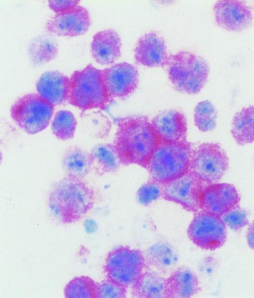Fig. 3. AIDS-related primary effusion lymphoma. The majority of tumor cells show strong cytoplasmic and membrane staining for B-B4 antibody, that recognizes the plasma cell specific CD138/syndecan-1 antigen. Cytospin preparation, APAAP immunostaining, hematoxylin counterstain. Original magnification ×400.