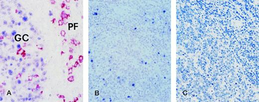 Fig. 4. Hyperplastic lymph node from an HIV-infected person with persistent generalized lymphadenopathy (PGL). (A) Two-color staining. Within a follicle numerous germinal center (GC) cells exhibit nuclear staining (blue) for BCL-6. In the same follicle, large cells with a plasma cell morphology show a strong cytoplasmic and membrane staining (reddish) with the anti-CD138/syndecan-1 MoAb. They are present within the GC and in the perifollicular (PF) zone. No co-expression of both markers by the same GC cell is detectable. Paraffin-embedded tissue section, no counterstain. (B) EBER in situ hybridization. EBER+ cells are localized around the hyperplastic follicle (right) and within the expanded germinal center (left). Paraffin-embedded tissue section, nuclear fast red counterstain. (C) Immunostaining for LMP-1. No LMP-1 expression by lymph node cells is detectable. Paraffin-embedded tissue section, APAAP method, hematoxylin counterstain. Original magnification ×250 (A), ×100 (B) and (C).