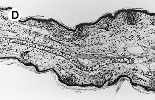 Fig. 3. IL-3 is required for hapten specific priming. (A) IL-3–deficient (□) and wild-type littermate controls (▪) (BALB/c) were tested for contact hypersensitivity to oxazolone. One hundred nanograms of murine IL-3 (in 1% mouse serum) (□) or vehicle only was administered intraperitoneally and subcutaneously (abdomen) 4 hours before, at the time of sensitization, and 6 hours afterwards. +/+ versus −/−, P = .03. −/− plus murine IL-3 versus −/−, P = .008. Murine IL-3 administered to unsensitized mice had no effect on secondary challenge. (B through D) Histopathology (tissues were formalin-fixed, paraffin-embedded, and stained with hematoxylin and eosin) of secondary oxazolone challenge sites in ears from mice (BALB/c background) killed 24 hours after challenge. (B) Ear reaction of a sensitized wild-type mouse. (C) Ear reaction of a sensitized IL-3–deficient mouse. (D) Ear reaction of a sensitized IL-3–deficient mouse administered IL-3 protein at the time of priming.