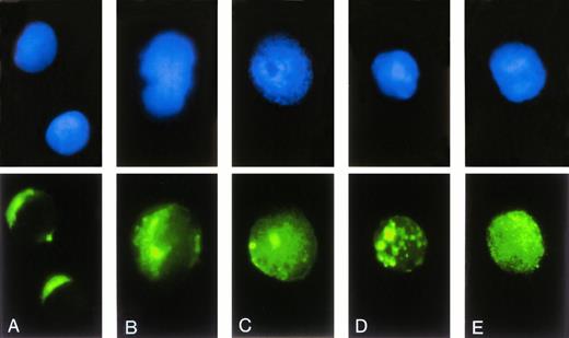 Fig. 3. Subcellular localization of FITC-labeled ODN. After transfection of 0.3 μmol/L FITC-labeled ODN using DOTAP, cells were transferred on slides by centrifugation, stained by DAPI, and analyzed by fluorescence microscopy. The upper row shows the DAPI stained nuclei, the lower row the intracellular distribution of FITC-labeled ODN. (A and B) Representative cells after incubation with ODN/DOTAP complexes for 2 hours. (C through E) Representative cells after an incubation time of 24 hours.
