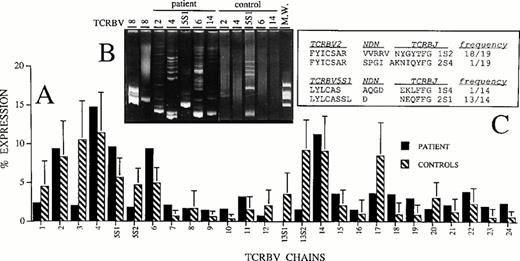 Fig. 2. (A) TCRBV usage in patient with AR-SCID (▪) and in healthy controls (▧). The relative percentage of TCRBV segments expression was calculated by normalizing the OD value of each individual TCRBV segment with respect to the sum of the OD values of all the 26 TCRBV chains as follows: % of expression:ODi∑I=126ODi×100(B) Heteroduplex analysis of the indicated TCRBV chains prepared from patient's and control's lymphocytes after PCR amplification performed with TCRBV-specific primers. TCRBV8 amplified products, obtained from the amplification of the J77 and C1-632 cells RNA29 were used as monoclonal and polyclonal controls and loaded, respectively, in the first and second lane of the gel. MW; molecular weight marker. (C) Junctional amino acid TCRBV2 and TCRBV5S1 sequences were deduced from nucleotide sequences and displayed as standard one-letter code. Only the last 3′ amino acids of the TCRBV segments and the first 5′ amino acids of TCRBJ chains are shown.