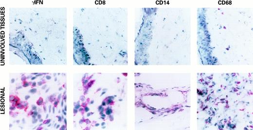 Fig. 1. Expression of γIFN, CD8, CD14, and CD68 in a representative KS lesion (lower panels, original magnification × 400) and uninvolved tissue (upper panels, original magnification × 1,000) by immunohistochemistry (APAAP) as described in Materials and Methods. Positivity for γIFN (red stain) was mostly observed in mononuclear cells, but also in spindle-shaped cells, as compared with uninvolved tissues. A strong increase in CD8+ and CD14+/CD68+ infiltrating cells, often with a subendothelial localization, was also observed in KS lesions, whereas these infiltrating cells are rare in uninvolved tissues. Similar results were obtained in all KS lesions analyzed, but were prevalent in early stage lesions.