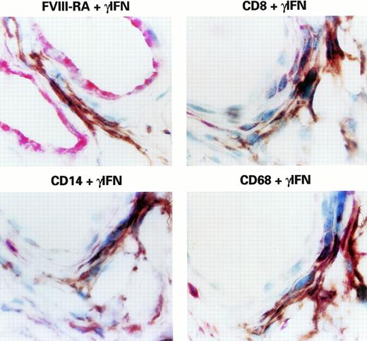 Fig. 2. Expression of γIFN by CD8+, CD14+, or CD68+ cells infiltrating KS lesions. Examples of double-staining by immunohistochemistry (APAAP/PAP) of γIFN and CD8, γIFN, and CD14 or CD68, γIFN, and FVIII-RA in a representative KS lesion. Similar results were obtained with other specimens. CD8+ cells (red stain) coexpressing γIFN (brown stain) had a mononuclear morphology (upper right panel), whereas anti-CD14 or anti-CD68 antibodies (red stain), recognizing monocytes-macrophages, costain γIFN+ (brown stain) spindle-shaped cells (lower left and right panels). In contrast, anti-γIFN antibodies (brown stain) do not stain FVIII-RA+ vessels (red stain, upper right panel), but γIFN+ cells are often localized in the proximity of vessels.