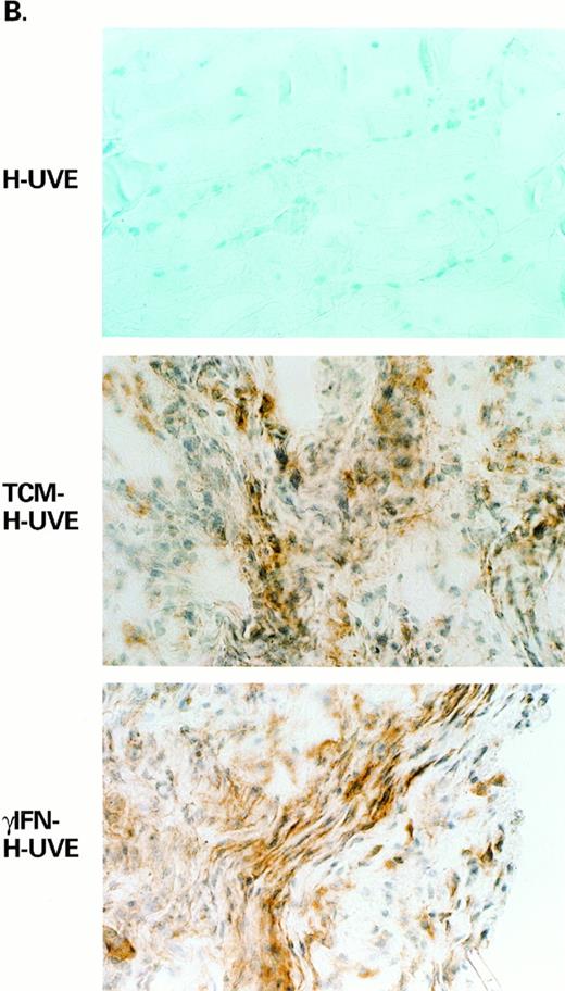Fig. 4. γIFN-treated or TCM-treated HUVE cells induce KS-like lesions in nude mice. Lesion formation is associated with expression of bFGF. (A) Shows examples of the histopathology (H & E staining, original magnification × 400) and (B) shows bFGF expression by immunohistochemistry in the same tissues from mice inoculated with untreated HUVE cells (HUVE), TCM-treated HUVE cells (TCM-HUVE), or γIFN-treated HUVE cells (γIFN-HUVE), respectively.