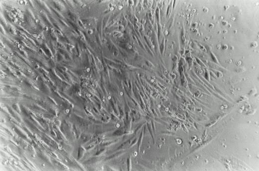 Fig. 1. Phase photomicrograph of cultured cells from a KS skin biopsy. Fragments of skin were minced and grown for 4 weeks in culture media containing TCM, as described in Materials and Methods (phase contrast 200×). A double population was obtained: one adherent with a spindle-shaped morphology and another of floating cells with a lymphoid morphology.
