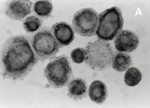 Fig. 3. Immunohistochemical analysis of cultured spindle-like cells derived from skin lesions. The cells were removed from the flask using a mild trypsinization cytocentrifuged and immunostained with MoAbs directed against CD68 (A), HLA-DR (B), and ICAM-1 (C) and counterstained with hematoxylin. The staining pattern for CD68 was cytoplasmic and diffuse (A), for HLA-DR, it was mainly granular (B), and for ICAM-1, it was more evident at the cell surface (C). The large majority of the cultured KS cells were HLA-DR positive. Magnifications are (A) ×630, (B) ×700, and (C) ×800.