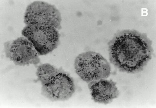 Fig. 3. Immunohistochemical analysis of cultured spindle-like cells derived from skin lesions. The cells were removed from the flask using a mild trypsinization cytocentrifuged and immunostained with MoAbs directed against CD68 (A), HLA-DR (B), and ICAM-1 (C) and counterstained with hematoxylin. The staining pattern for CD68 was cytoplasmic and diffuse (A), for HLA-DR, it was mainly granular (B), and for ICAM-1, it was more evident at the cell surface (C). The large majority of the cultured KS cells were HLA-DR positive. Magnifications are (A) ×630, (B) ×700, and (C) ×800.