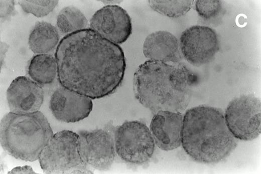 Fig. 3. Immunohistochemical analysis of cultured spindle-like cells derived from skin lesions. The cells were removed from the flask using a mild trypsinization cytocentrifuged and immunostained with MoAbs directed against CD68 (A), HLA-DR (B), and ICAM-1 (C) and counterstained with hematoxylin. The staining pattern for CD68 was cytoplasmic and diffuse (A), for HLA-DR, it was mainly granular (B), and for ICAM-1, it was more evident at the cell surface (C). The large majority of the cultured KS cells were HLA-DR positive. Magnifications are (A) ×630, (B) ×700, and (C) ×800.