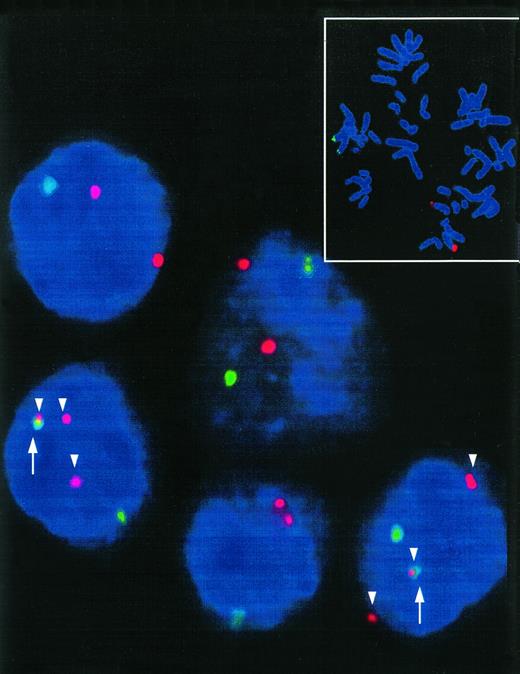 Fig. 2. Interphase nuclei of a t(8;14)+ Burkitt's type ALL. Two interphase nuclei meeting the type I hybridization pattern show three red signals (c-myc-split, arrowhead) and colocalization (arrow) of one of these signals with a green COS-cα1 signal indicative for a t(8;14). Small picture: t(8;14)− control metaphase showing the location of the FISH probes. Distinct red (c-myc) and green (IgH) signals can be detected in the region 8q24 and 14q32, respectively.