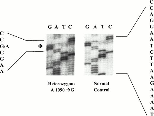 Fig. 3. DNA sequence analysis of an abnormal amplified fragment of exon 7 of factor V gene. A heterozygous A1090→G mutation was identified.