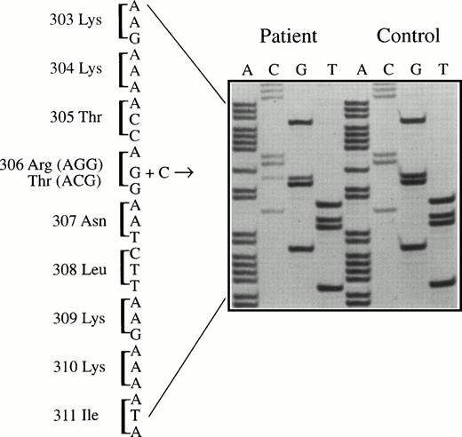 Fig. 1. Sequencing of amplified factor V exon 7 DNA from the patient and a normal control. The mutation (G to C) is present at codon 306, resulting in an arginine306→threonine substitution in the factor V protein (factor V Cambridge).