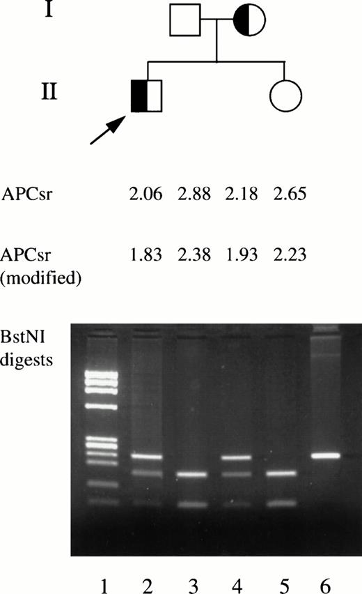Fig. 2. Family study of factor V Cambridge pedigree. The standard and modified APC sensitivity ratios and BstNI restriction enzyme digestion of exon 7 DNA are shown. Lane 1, DNA size markers. Lanes 2 through 5, BstNI digestion of DNA from family members. Lane 6, undigested exon 7 DNA fragment.