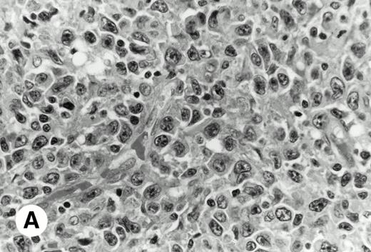 Fig. 1. De novo CD5+ DLBL (case no. 1, stomach). (A) Diffuse infiltration of large neoplastic cells is observed (hematoxylin and eosin). (B) Frozen section stained for CD5 shows strong staining of atypical large cells and concomitant normal T cells.