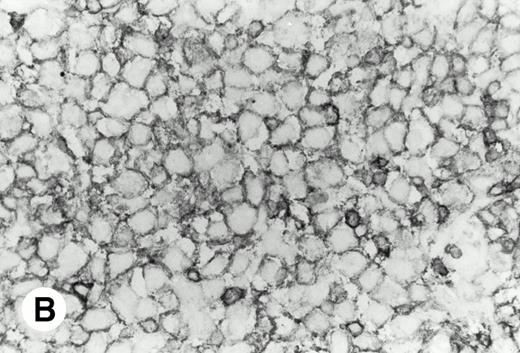 Fig. 1. De novo CD5+ DLBL (case no. 1, stomach). (A) Diffuse infiltration of large neoplastic cells is observed (hematoxylin and eosin). (B) Frozen section stained for CD5 shows strong staining of atypical large cells and concomitant normal T cells.