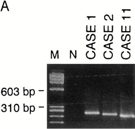 Fig. 2. Examples of PCR amplification of de novo CD5+ DLBLs with genomic DNA of cases no. 1, 2, and 11 (A) and with cDNA of cases no. 1, 2, 6, and 11 (B). PCR products were electrophoresed on a 4% agarose gel, stained with ethidium bromide, and visualized under UV light. Lane M, molecular weight standard ◊X174/Hae III. Lane N, negative control. (A) Cases no. 1, 2, and 11 all presented monoclonal patterns whose VH genes were amplified. (B) VH1 through VH6 were amplified with corresponding VH1 to VH6 gene family-specific leader primer and a JH primer, respectively. In cases no. 1, 2, and 11, monoclonal patterns were obtained only in one of VH families, whereas in case no. 6, they were obtained in two VH families (VH3 and VH5). However, PCR products of VH3 in case no. 6 were polyclonal, as confirmed by sequencing.