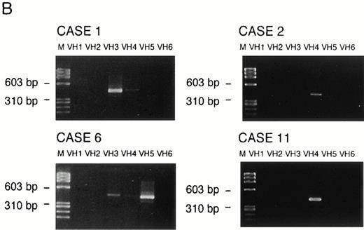 Fig. 2. Examples of PCR amplification of de novo CD5+ DLBLs with genomic DNA of cases no. 1, 2, and 11 (A) and with cDNA of cases no. 1, 2, 6, and 11 (B). PCR products were electrophoresed on a 4% agarose gel, stained with ethidium bromide, and visualized under UV light. Lane M, molecular weight standard ◊X174/Hae III. Lane N, negative control. (A) Cases no. 1, 2, and 11 all presented monoclonal patterns whose VH genes were amplified. (B) VH1 through VH6 were amplified with corresponding VH1 to VH6 gene family-specific leader primer and a JH primer, respectively. In cases no. 1, 2, and 11, monoclonal patterns were obtained only in one of VH families, whereas in case no. 6, they were obtained in two VH families (VH3 and VH5). However, PCR products of VH3 in case no. 6 were polyclonal, as confirmed by sequencing.