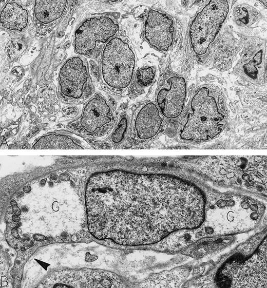 Hemangiopericytoma. An asymptomatic 73-year-old man was found to have a large retroperitoneal mass on routine physical examination. This was confirmed by computer tomography scan; at surgery, the mass did not involve any abdominal organs. Immunoperoxidase stains were positive for vimentin and negative for actin, desmin, neurofilament, keratin, and S-100 protein. Electron microscopy showed a tumor composed of pericytes, illustrated at low magnification in cross-section (A) and at higher magnification in longitudinal section (B). Note the dispersed nuclear chromatin pattern and the paucity of cellular organelles in the cytoplasm. Focal strips of basal lamina beneath extended cytoplasmic processes (arrowhead) and cytoplasmic glycogen pools (G) characterize these neoplastic pericytes. Original magnifications: (A), ×3,500; (B), ×13,000. (Courtesy of Ann M. Dvorak, MD, Department of Pathology, Beth Israel Deaconess Medical Center, 330 Brookline Ave, Boston, MA 02215.)