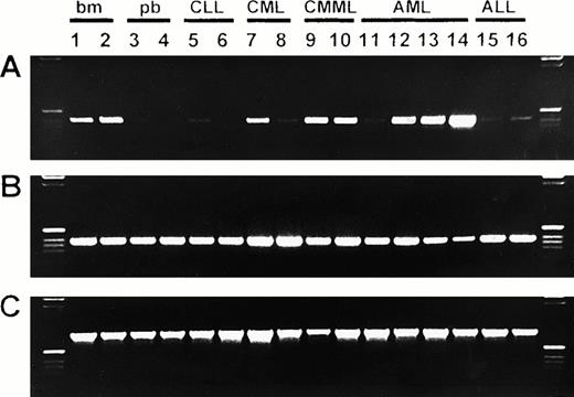 Fig. 1. Expression of bomapin, CAP, and β-actin in normal hematopoiesis and in hematological malignancies. RNA was isolated from normal bone marrow (bm; lanes 1-2) and from peripheral blood of normal donors (pb; lanes 3-4) and patients with CLL (lanes 5-6), CML (lanes 7-8), CMML (lanes 9-10), AML (lanes 11-14), and ALL (lanes 15-16). After reverse transcription, bomapin (A) and CAP (B) cDNAs were amplified by PCR for 32 cycles using primer pairs B1 (amplification product, 403 base pairs) and C1 (amplification product, 385 base pairs), respectively. The β-actin (C) cDNA was amplified for 24 cycles (amplification product, 796 base pairs). PCR products (5 μL) were visualized by electrophoresis in a 1.5% agarose gel followed by staining with ethidium bromide. A 1-kb DNA ladder was loaded in the left and right lanes. Bomapin expression was scored to be low or absent in lanes 3-6, 8, 11, and 15-16; medium in lanes 1-2, 7, 9-10, and 12-13; and high in lane 14.