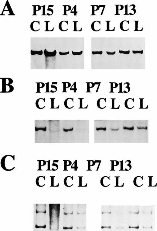 Fig. 4. Autoradiographs of leukemic DNA samples from patients P15, P4, P7, and P13 and control (C) and leukemic (L) samples were digested with the restriction enzyme EcoRI, size fractionated through 1% agarose gel, and hybridized with the following probes: (A) control probe renin; (B) p9E4.3, with densitometry results compared with the control signals of 0.05, 0.04, 0.40, and 0.53, showing homozygous loss for P15 and P4 and hemizygous loss for samples P7 and P13, respectively; and (C) showing the same samples hybridized with the probes (I, upper band) p6E3.2, a 800-bp EcoRI MluI probe isolated from the same genomic 3-kb EcoRI fragment as the polymorphic 6E3.2 marker, with densitometry results compared with the control signals of 0.08, 0.46, 0.41, and 0.47, respectively, showing homozygous loss, hemizygous loss, hemizygous loss, and hemizygous loss, respectively and (II, lower band) p9a, a 2-kb EcoRI fragment isolated in the overlapping region between cosmids C9a and C29a, with densitometry results compared with the control signals of 0.03, 0.48, 0.42, and 0.49, respectively, showing homozygous loss, hemizygous loss, hemizygous loss, and hemizygous loss, respectively.