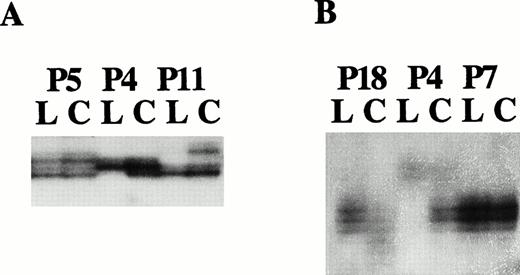 Fig. 5. Examples of microsatellite analysis with markers (A) D13S272 and (B) 6E3.2. (A) The lanes corresponding to the leukemic (L) and control (C) cell populations of patients P5, P4, and P11 show biallelic retention, hemizygous loss, and hemizygous loss, respectively. (B) The lanes corresponding to the leukemic (L) and control (C) cell populations of patients P18, P4, and P7 show hemizygous loss, hemizygous loss, and noninformativity, respectively.