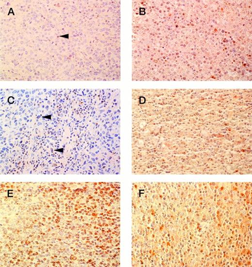 Fig. 2. Representative immunoperoxidase with anti–Bcl-2 and anti-Bax antisera. (A) anti–Bcl-2 study of lymphoma negative for Bcl-2 (arrowhead indicates positive staining in background small lymphocyte); (B) same case as (A) showing positive staining in greater than 20% of lymphoma cells with anti-Bax antisera; (C) anti–Bcl-2 study of lymphoma showing Bcl-2 positivity in fewer than 20% of the neoplastic cells (arrowheads indicate positive large atypical cells); (D) same as (C) showing positive staining in greater than 20% of lymphoma cells with anti-Bax antisera; (E) anti–Bcl-2 study of lymphoma showing Bcl-2 positivity in greater than 20% of the neoplastic cells; (F) same case as (E) showing lymphoma with greater than 20% of cells positive for Bax.