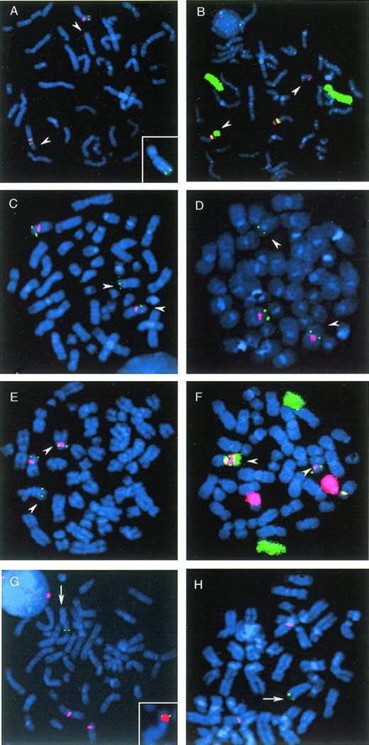 Fig. 2. FISH analysis of ETV6 rearrangements. (A) Case 1 with a t(5;12)(q31;p13); (B) case 2 with a t(6;12;17)(p21;p13;q25), (C) case 3 with a t(7;12)(p15;p13); (D) case 4 with a t(7;12)(p12;p13); (E) case 5 with a t(7;12)(q36;p13); (F) case 6 with a t(12;13)(p13;q12); and (G and H) case 7 with a der(12)t(5;12;?)(p11;p11p13;?). (A through F) arrowheads indicate derivatives of particular t(12)(p13); (G and H) arrows indicate der(5) and der(14) chromosomes, respectively. All green signals result from probes labeled with a bio-16-dUTP, red signals are generated by probes labeled with Texas Red-5-dUTP, yellow signals result from a mixture of bio-16-dUTP–labeled and Texas Red-5-dUTP–labeled probes in ratio 2;1. The probes used for FISH include (A) cosmid 67C6 (green) and a chromosome 12 centromeric probe pBR12 (red); (A inset) cosmid 179A6 (green); (B) cosmid 15A4 (red), library 6 (green) and pBR12 (yellow); (C) mixture of two cosmids 50F4 and 132B11 (green) and pBR12 (red); (D) cosmid 179A6 (green) and pBR12 (red); (E) cosmid 50F4 (green) and pBR12 (red); (F) cosmid 54D5 and library 9 (green), library 13 (red) and a chromosome 12 centromeric probe pBR12 (yellow); (G) cosmid 148B6 (green) and pBR12 (red); (G inset) cosmid 163E7 (green) and library 12 (red); and (H) cosmid 179A6 (green) and pBR12 (red). Note the hybridization of 179A6 and 67C6 to a der(5) and der(12), respectively, in case 1; hybridization of 15A4 with a der(12) and der(17) in case 2; separation of 50F4 and 132B11 cosmids on both derivative chromosomes in case 3; split signal from 179A6 and 50F4 in cases 4 and 5, respectively; split signal from 54D5 on der(12) and der(13), absence of a second 54D5 signal on a del(12)(p12p13), and presence of a chromosome 13 and 9 material on a der(12) in case 6; appearance of only one hybridization signal from cosmids 148B6 (G) and 179A6 (H) on a der(5) and a der(14), respectively, and the presence of additional material on a der(5)t(5;12;?)(p11;p11p13;?) upstream of theETV6-specific cosmid 163E7 (G inset) in case 7.