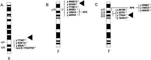 Fig. 3. Localization of probes from chromosome 5q or 7p used for FISH detection of the breakpoints in case 1 with a t(5;12)(q31;p13) (A), case 3 with a t(7;12)(p15;p13) (B), and case 4 with a t(7;12)(p12;p13) (C). Abbreviations: (A) Asterisk (*) indicates hybridization with a der(12)t(5;12); (B) plus sign (+) indicates hybridization with a der(7)t(7;12) and sindicates split signal on der(7) and der(12); (C) ° indicates hybridization with a der(12)t(7;12), and asterisk (*) indicates hybridization with a der(7)t(7;12); ◂ indicates position of breakpoint.